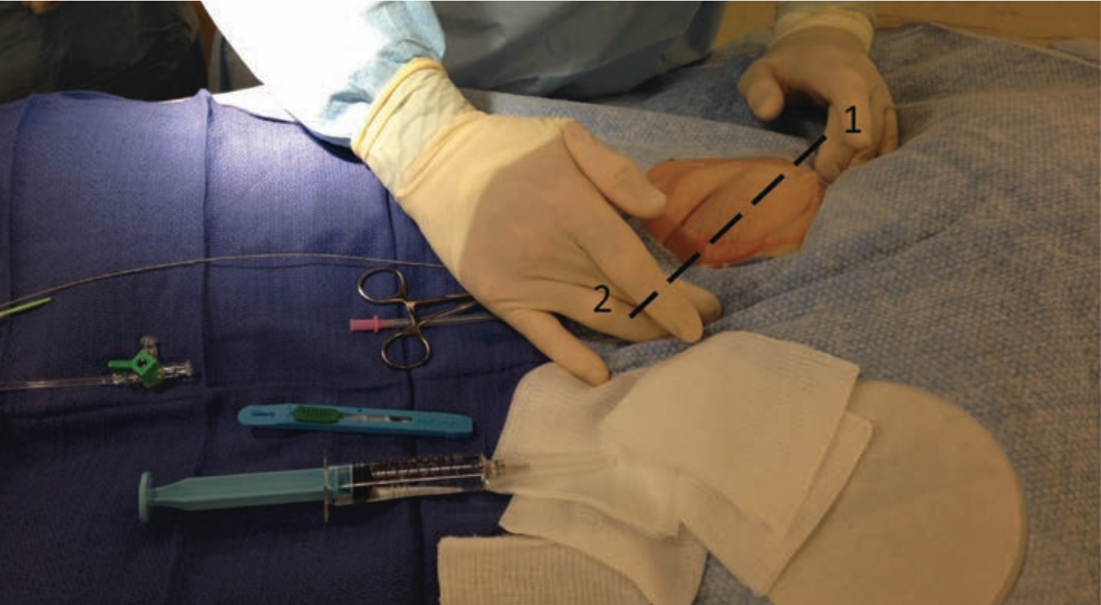 Back to Basics Femoral Artery Access and Hemostasis